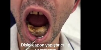 (ویدیو) شوکه شدن دندان‌پزشک ترک از اقدام عجیب یک مرد برای جلوگیری از افتادن دندان‌هایش/ چسب مایع زده دندوناش نیوفته/من هیچ! من نگاه!