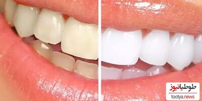 4 روش سفید کردن دندان‌ های زرد در خانه / با بلیچینگ خداحافظی کنید !