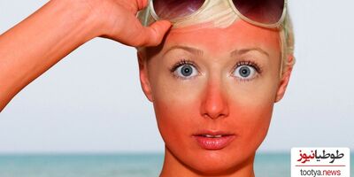 روش های موثر برای سفید کردن پوست آفتاب سوخته