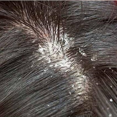 دلایل پوسته پوسته شدن یا پوسته ریزی چیست؟